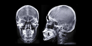 X-rays of the human skull 